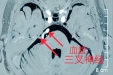 花甲老人深受脸部剧痛困扰 原来是三叉神经惹的祸