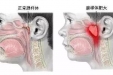 【健康科普】腺样体肥大？中医儿科医师教你消“腺”